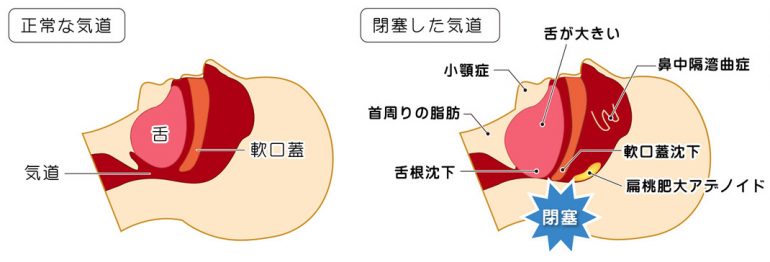 睡眠時無呼吸症候群（SAS）の原因