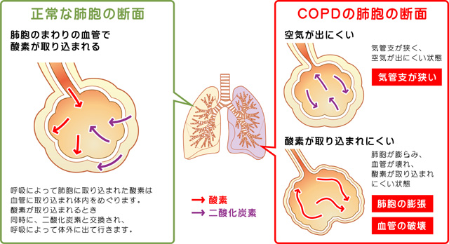 COPD